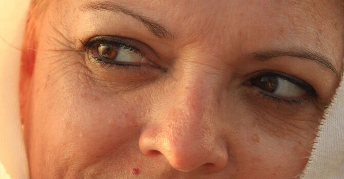 Melasma/Hyperpigmentation