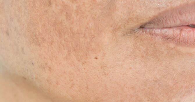 Uneven Skin Tone & Texture