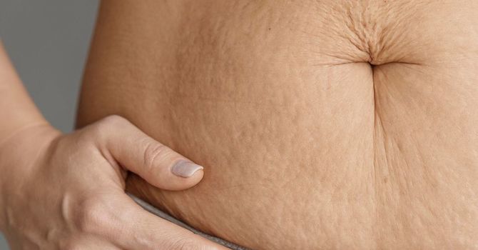 Stretch Marks