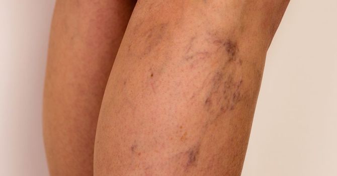 Spider Veins