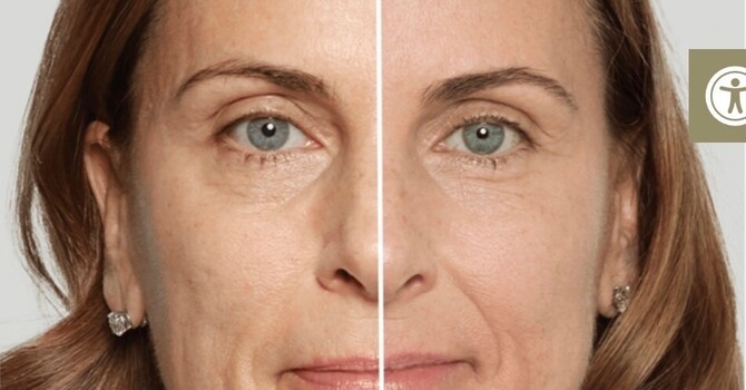 Sculptra